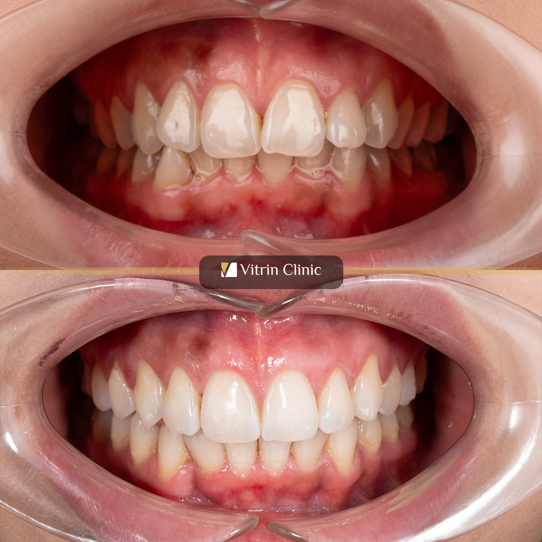 Invisalign